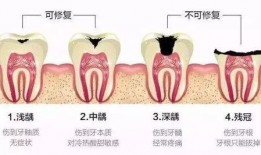 根管治疗视频,从视频学习根管治疗技巧与流程